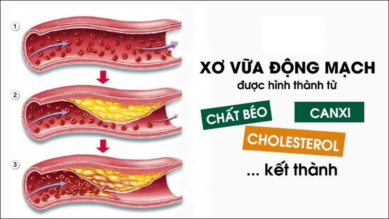 Nguyên nhân chính gây xơ vữa động mạch