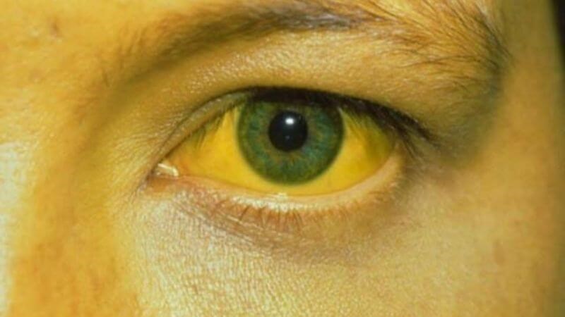 Khi có dấu hiệu vàng da, vàng mắt nên đến các cơ sở y tế để thăm khám