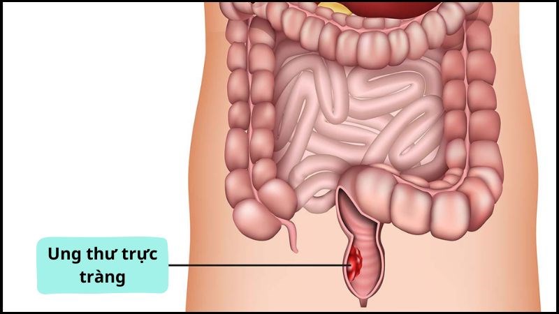 Trực Tràng Là Bệnh Gì? Hiểu Rõ Về Các Vấn Đề Liên Quan Đến Sức Khỏe