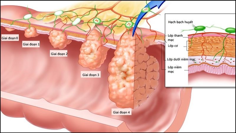 Các giai đoạn của ung thư trực tràng