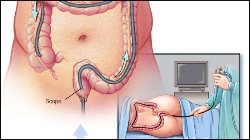 Nội soi đại trực tràng