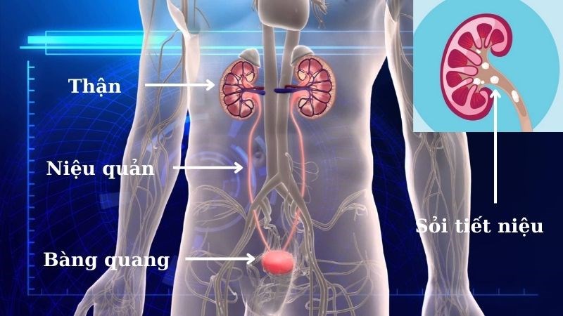 Các vị trí của sỏi tiết niệu Các vị trí của sỏi tiết niệu