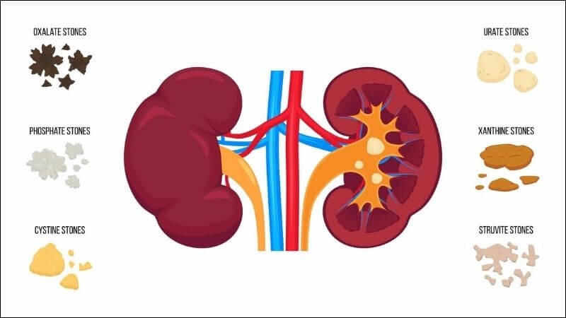 Phân loại sỏi theo thành phần hóa học Phân loại sỏi theo thành phần hóa học