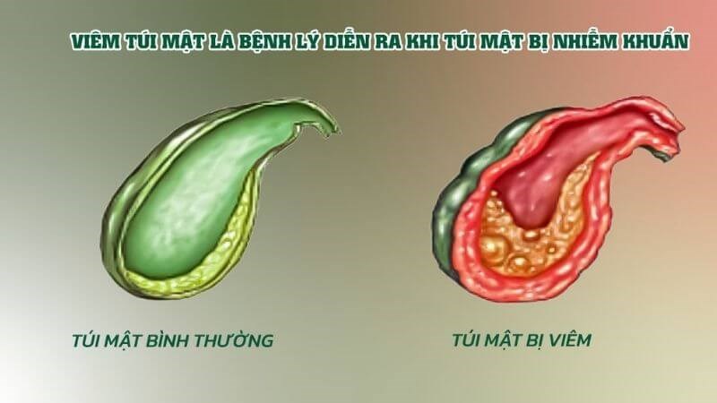 Sỏi mật là nguyên nhân hay gặp nhất gây viêm túi mật Sỏi mật là nguyên nhân hay gặp nhất gây viêm túi mật
