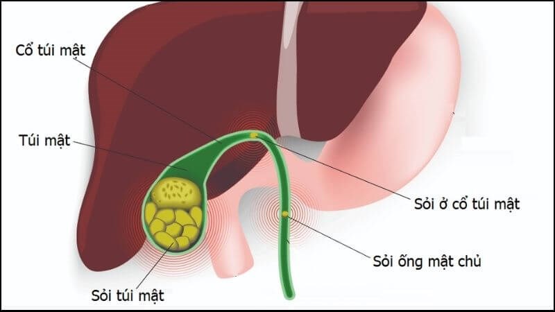 Viêm túi mật mạn tính