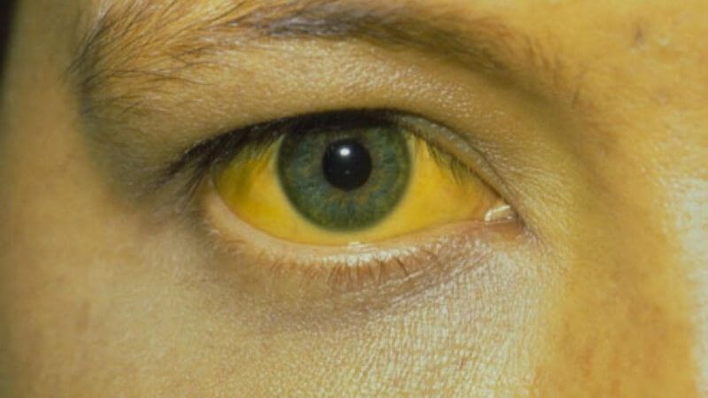 Vàng mắt là đặc điểm chỉ báo bệnh gan, mật