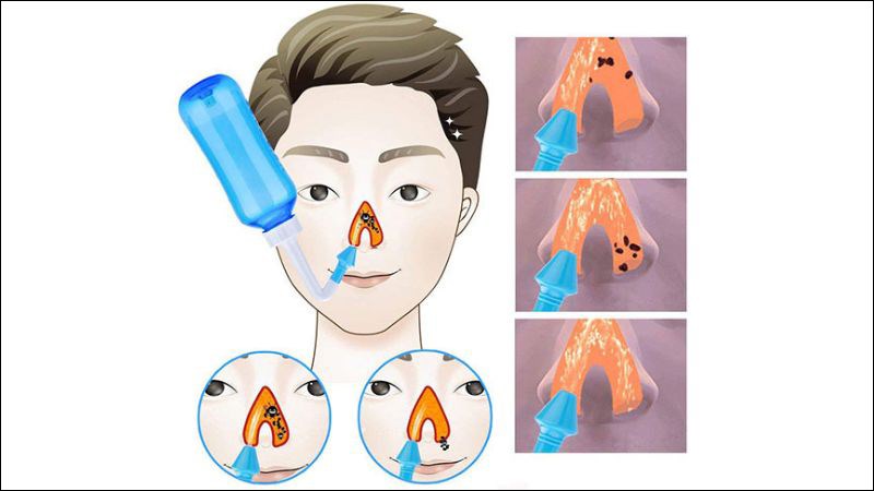 Rửa mũi bằng nước muối sinh lý đúng cách Rửa mũi bằng nước muối sinh lý đúng cách