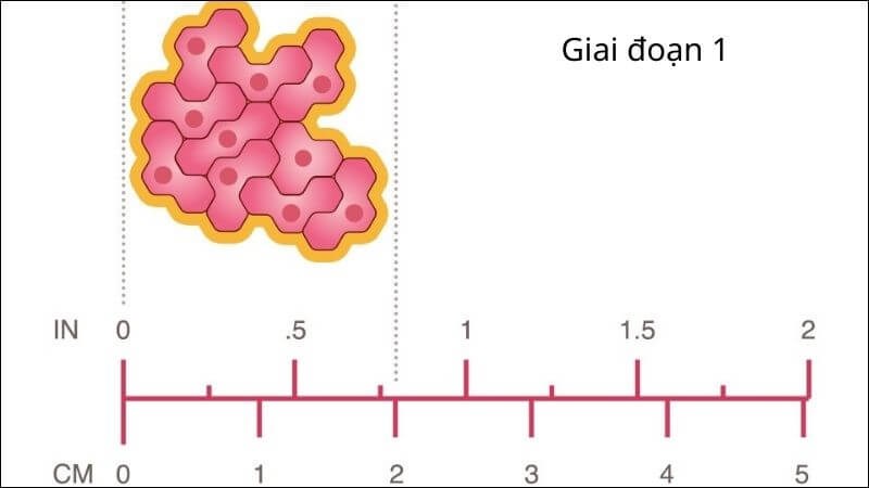 Giai đoạn 1 đã lan ra các mô lành nhưng kích thước nhỏ