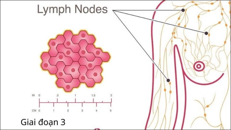 Giai đoạn 3 đã lan đến các hạch bạch huyết lân cận
