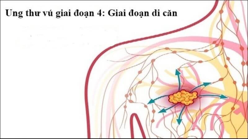 Giai đoạn 4 có di căn xa