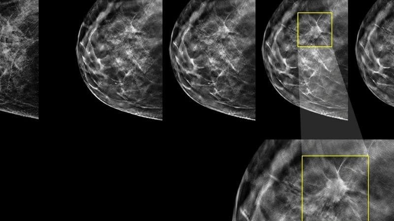 Sử dụng nhũ ảnh để tầm soát ung thư vú
