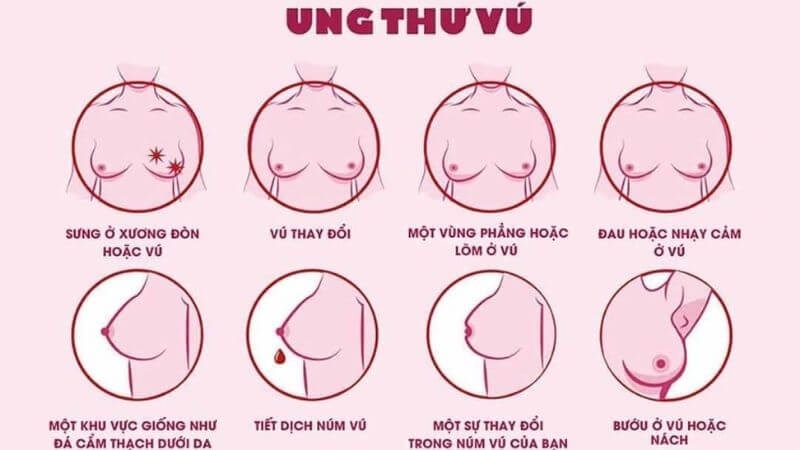 Các dấu hiệu của ung thư vú