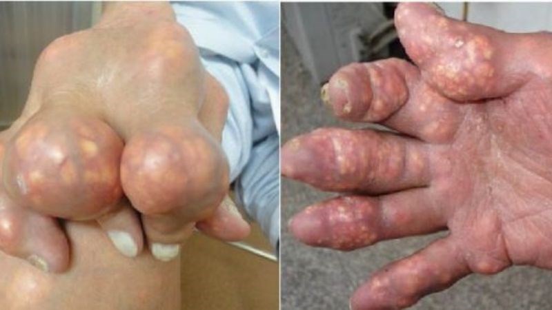 6. Các giai đoạn của bệnh Gout