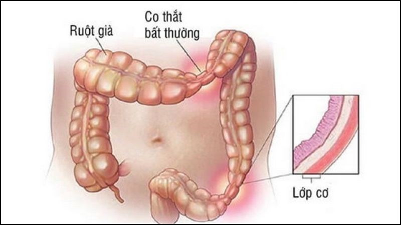 Cường độ co thắt bất thường của các cơ trong ruột là nguyên nhân dẫn đến IBS Cường độ co thắt bất thường của các cơ trong ruột là nguyên nhân dẫn đến IBS