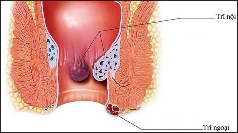 IBS có liên quan đến bệnh trĩ do táo bón hoặc tiêu chảy mãn tính IBS có liên quan đến bệnh trĩ do táo bón hoặc tiêu chảy mãn tính