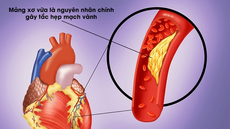 Xơ vữa động mạch l&agrave; nguy&ecirc;n nh&acirc;n ch&iacute;nh dẫn đến bệnh