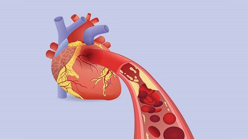 Bệnh mạch v&agrave;nh li&ecirc;n quan đến giảm lưu lượng m&aacute;u ở động mạch v&agrave;nh