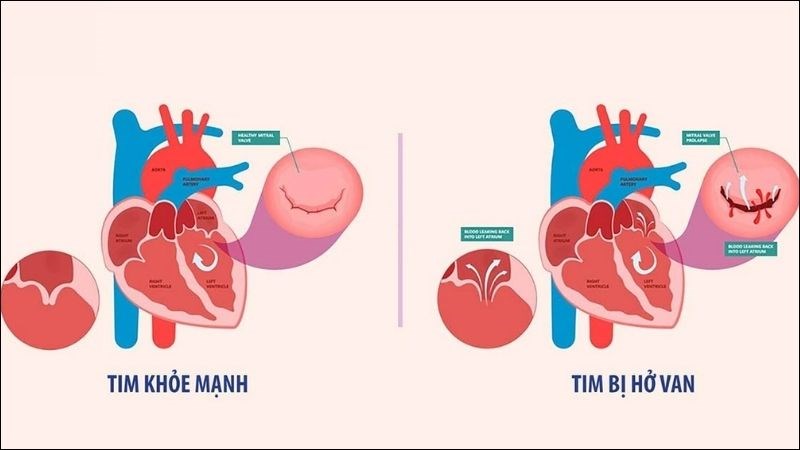 Bệnh van tim sẽ làm suy yếu tim theo thời gian Bệnh van tim sẽ làm suy yếu tim theo thời gian