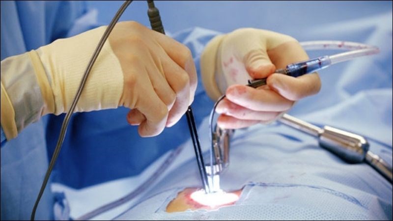 Phẫu thuật Phẫu thuật bắc cầu mạch vành để điều trị suy tim
