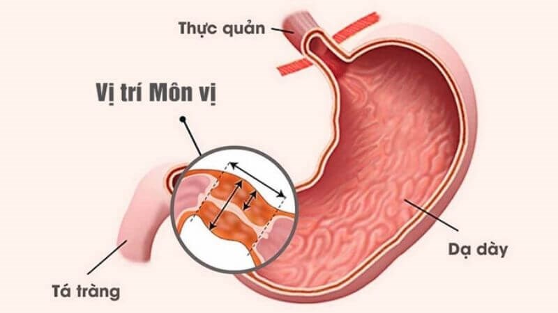 Hẹp môn vị là biến chứng hay gặp của ung thư dạ dày