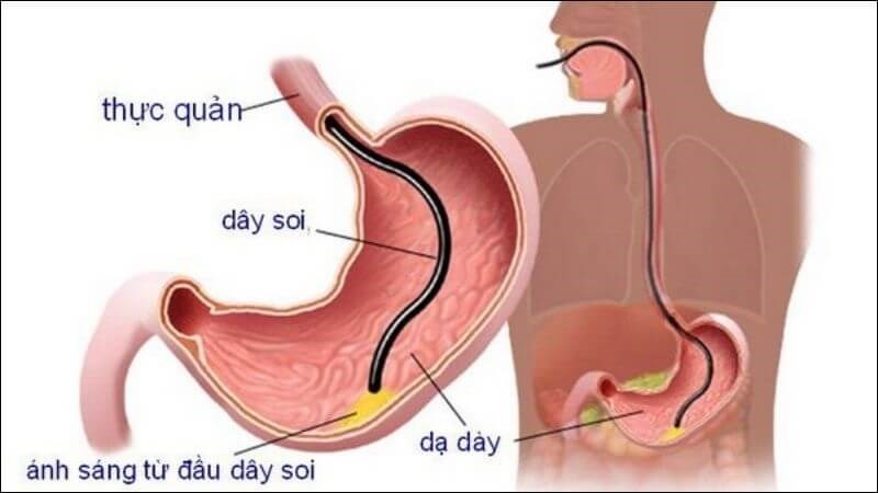 Nội soi là phương pháp tốt nhất để thu được hình ảnh bên trong dạ dày