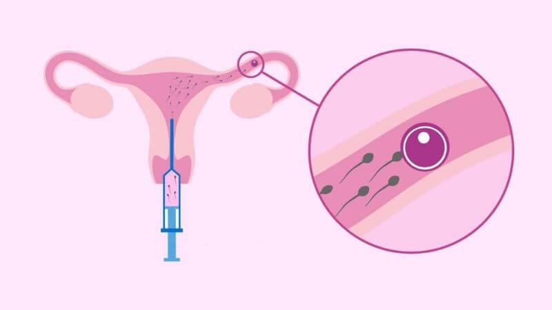 Thụ tinh trong tử cung giúp tăng khả năng thụ thai