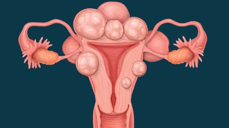 U xơ tử cung là nguyên nhân gây hiếm muộn ở nữ