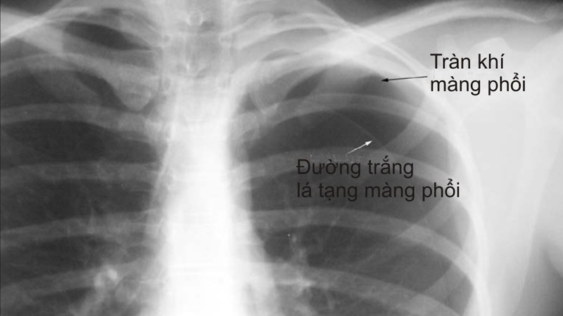 Tràn khí màng phổi là một biến chứng nguy hiểm