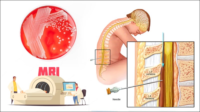 Các phương pháp chẩn đoán viêm màng não