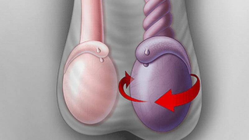 Xoắn tinh hoàn một trong những biến chứng của tinh hoàn ẩn