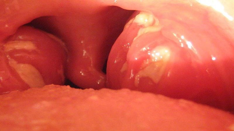 Viêm amidan cấp tình thường bị sung huyết đỏ