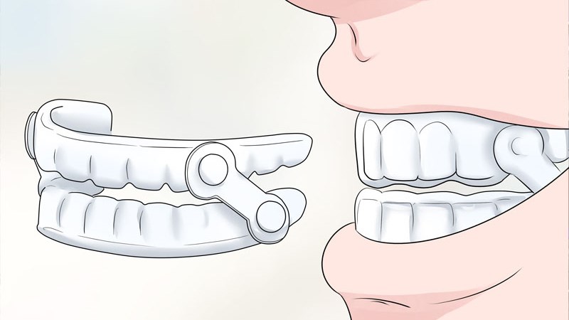 Khí cụ răng miệng có thể giúp đường thở luôn thông thoáng, hỗ trợ điều trị chứng ngưng thở khi ngủ