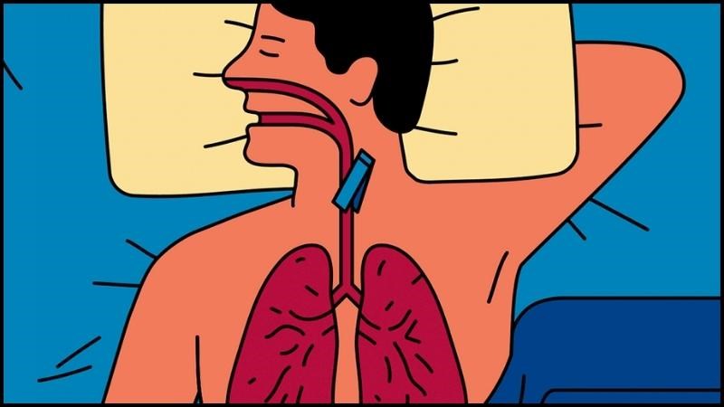 Chứng ngưng thở khi ngủ do tắc nghẽn đường hô hấp trên