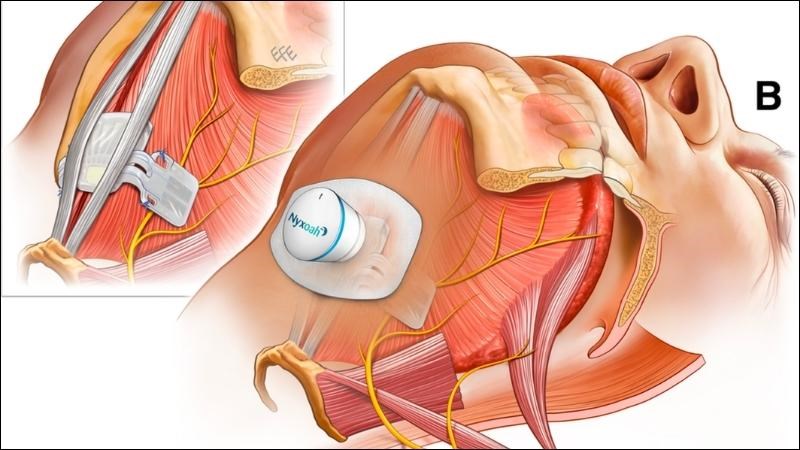 Máy kích thích thần kinh giúp tránh lưỡi đè lên khí quản khi ngủ