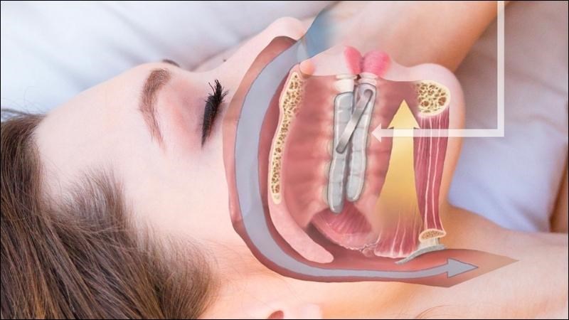 Dụng cụ hỗ trợ miệng có thể thay thế cho máy thở áp lực dương