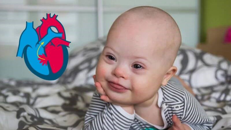 Tim bẩm sinh có thể là một biến chứng của hội chứng Down