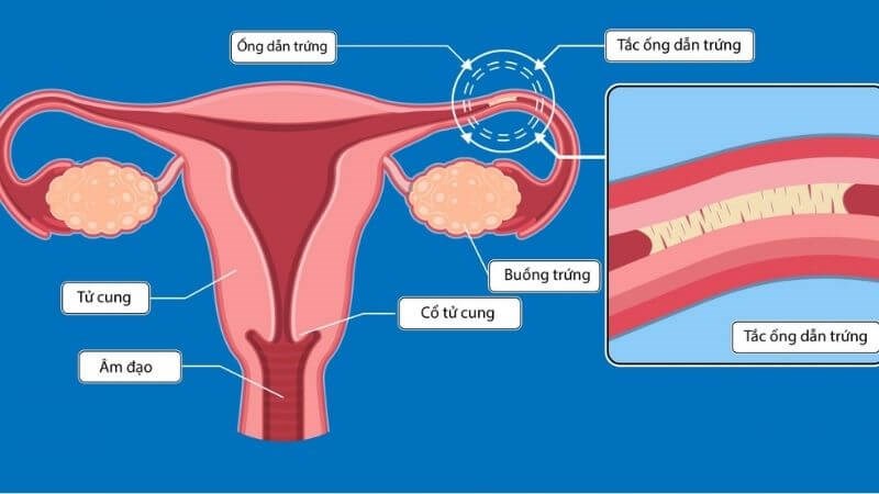 Xơ sẹo ở ống dẫn trứng có thể là nguyên nhân của thai ngoài tử cung