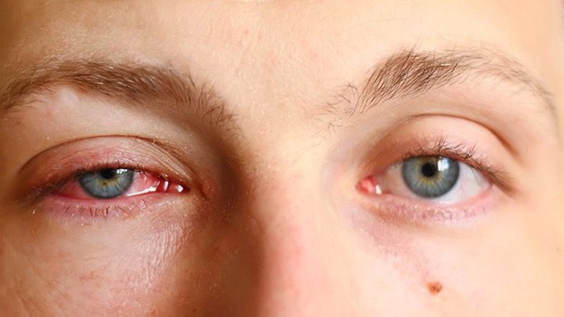 Bệnh đau mắt hột là một vấn đề sức khỏe cộng đồng gây mù lòa hàng đầu trên thế giới