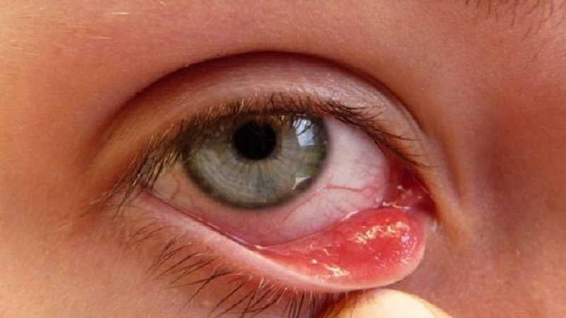 Bệnh đau mắt hột có thể tự khỏi 
