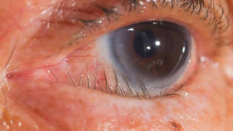 Phương pháp xoay mí mắt là biện pháp điều trị ngoại khoa do di chứng của bệnh đau mắt hột