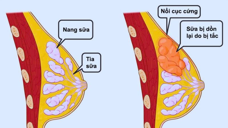 Sữa bị dồn lại thành cục trong bầu vú gây đau