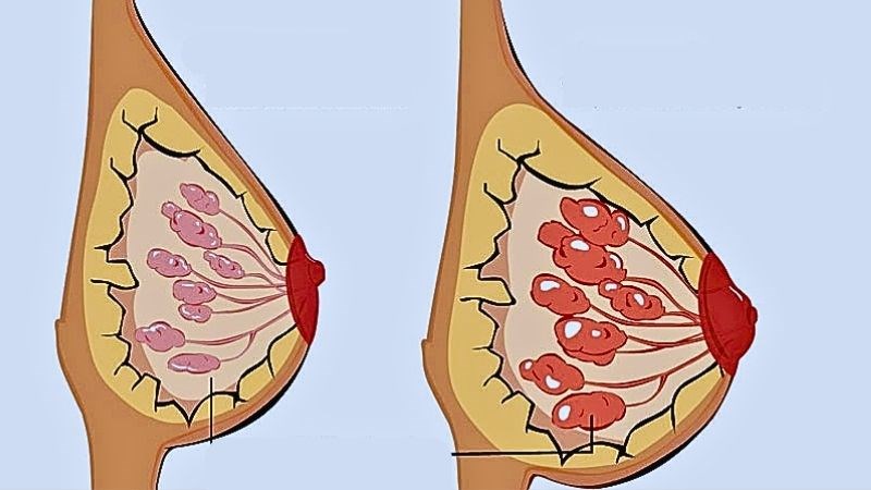 Mẹ quá nhiều sữa khiến sữa bị trữ lại dẫn đến vón cục và gây tắc tia sữa