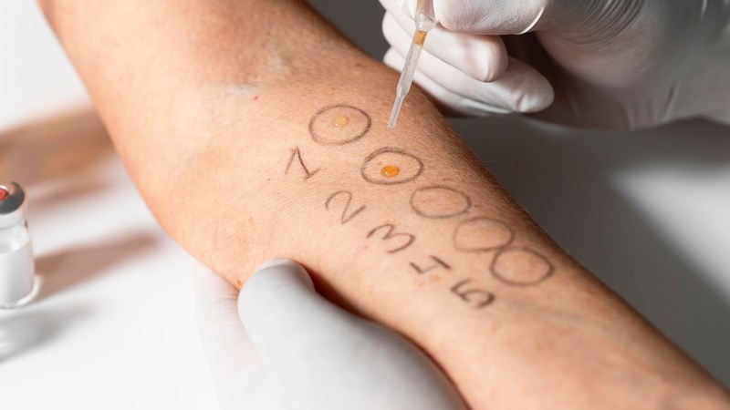 Có thể test da để chẩn đoán sốc phản vệ Có thể test da để chẩn đoán sốc phản vệ
