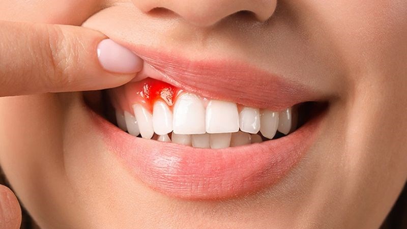 Nướu sưng đỏ là dấu hiệu cần đến gặp bác sĩ sớm