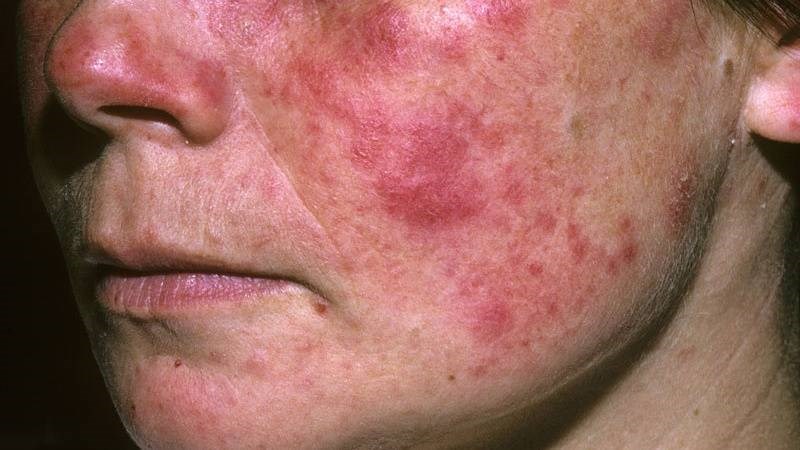 Lupus ban đỏ là một trong những nguyên nhân gây hội chứng thận hư
