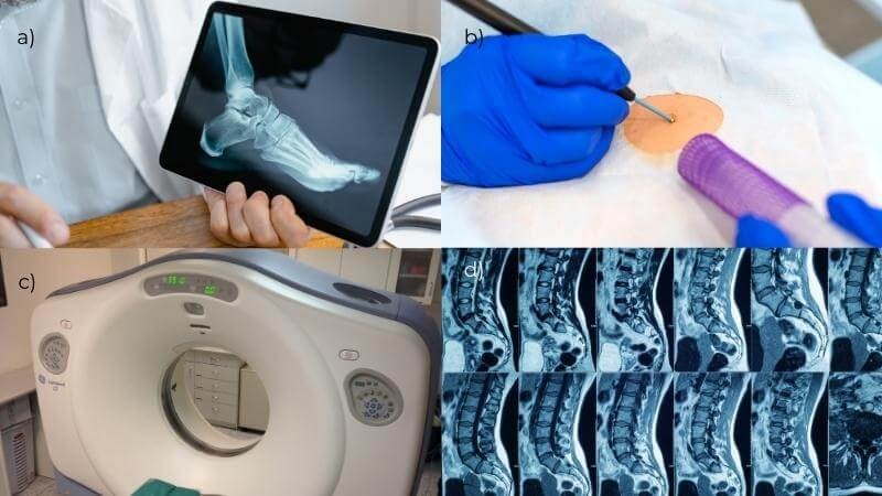 Ung thư xương là gì? Nguyên nhân, dấu hiệu, biến chứng và điều trị Ung thư xương là gì? Nguyên nhân, dấu hiệu, biến chứng và điều trị