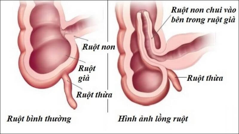 Lồng ruột là hiện tượng một đoạn ruột phía dưới chui ngược lên phần ruột phía trên Lồng ruột là hiện tượng một đoạn ruột phía dưới chui ngược lên phần ruột phía trên