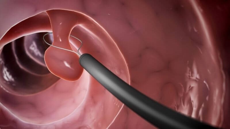 Khối polyp đường tiêu hóa có thể là nguyên nhân gây lồng ruột ở người lớn Khối polyp đường tiêu hóa có thể là nguyên nhân gây lồng ruột ở người lớn