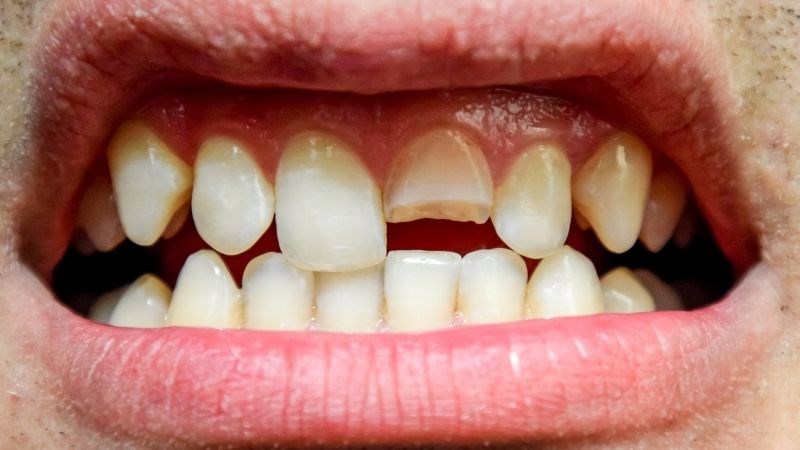 Nghiến răng khi ngủ có thể gây mẻ răng, gãy răng