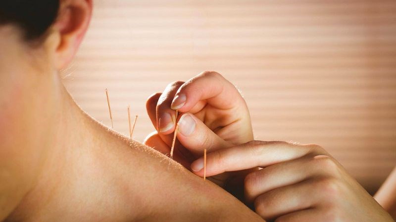 Châm cứu là một phương pháp điều trị mất ngủ có nguồn gốc từ Đông y